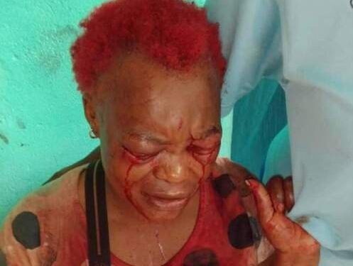 Un Camerounais crève les yeux de sa concubine et lui arrache l'oreille à l'aide d'un couteau