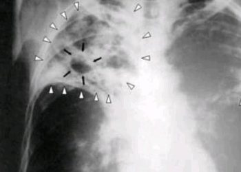 Tuberculose à Nkolabona